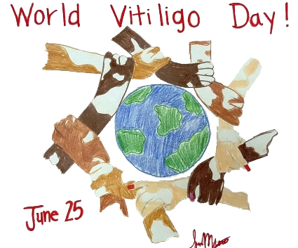 India berjuang mematahkan mitos seputar vitiligo