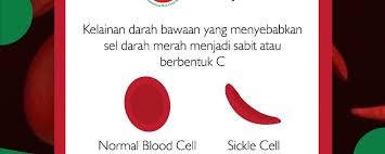 anemia sel sabit